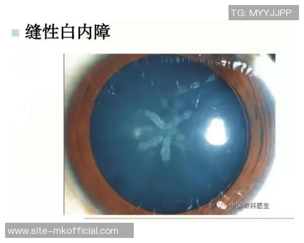 西媒揭示赫伊森眼睛难以睁开的原因是先天性眼睑下垂但不影响视力 西媒揭示赫伊森眼睛难以睁开的原因是先天性眼睑下垂但不影响视力